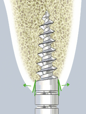 mectron bone expander