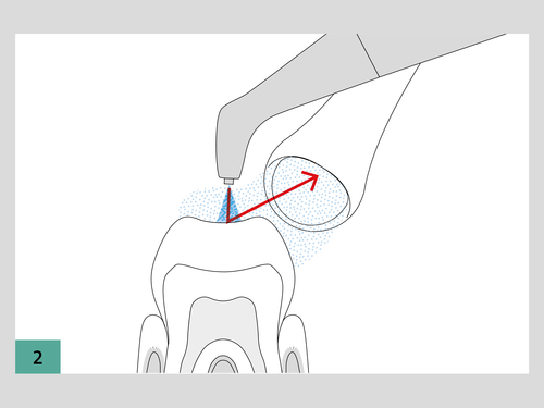 how to use the handpieces fig 2
