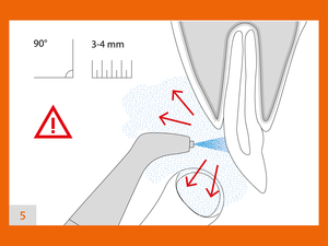 how to use the handpieces fig 5